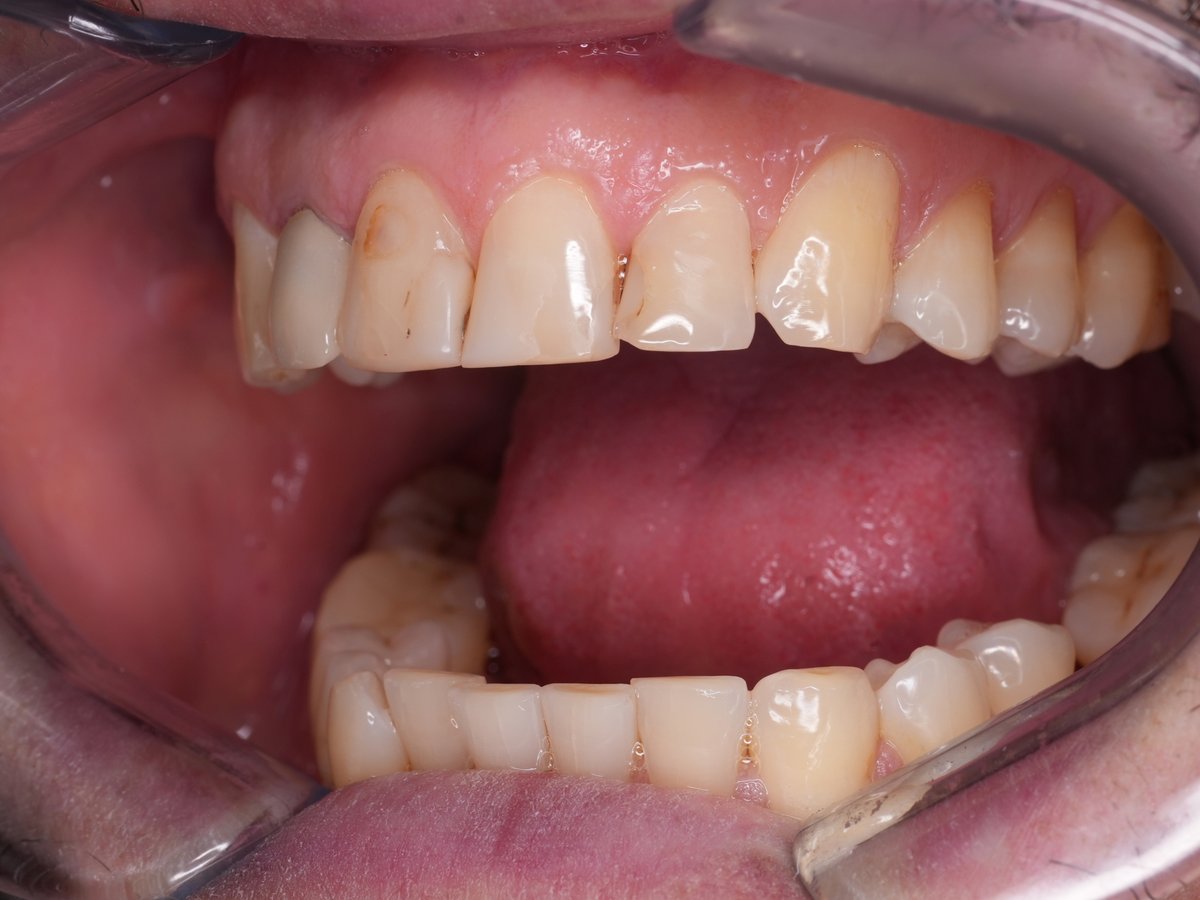 Voor de behandeling: close-up van de verkleurde vullingen.
